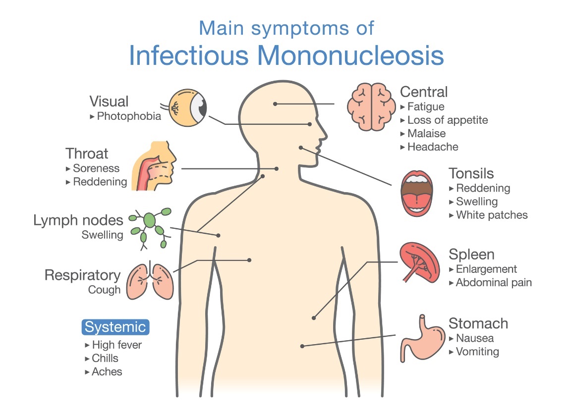 Symptomy infekční mononukleózy