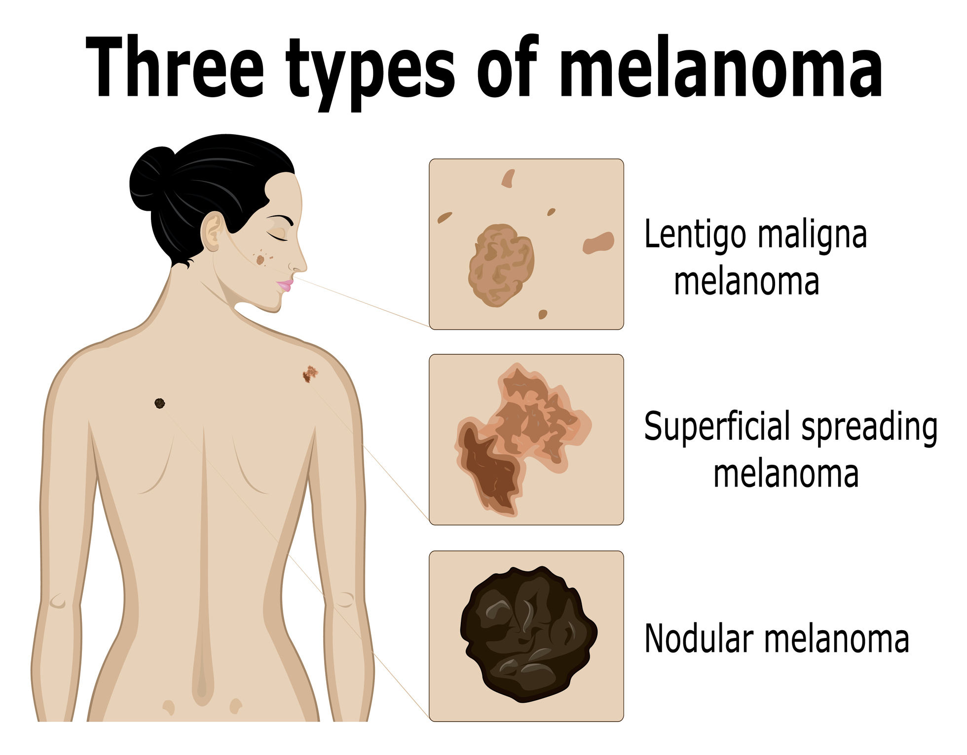 Zobrazení tří typů melanomu