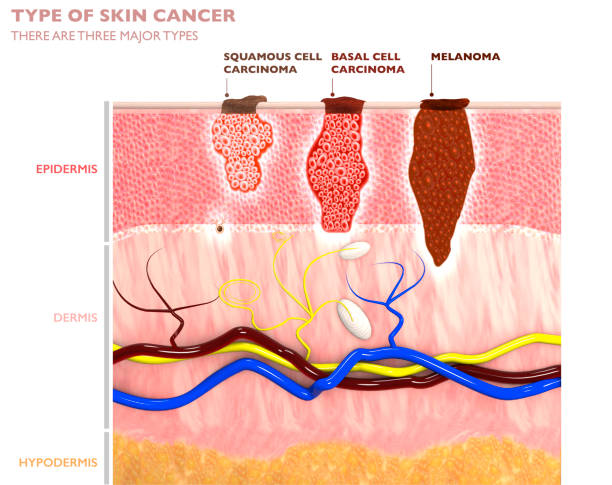 Typy kožních nádorů, jejich prorůstání do kůže – spinocelulární karcinom, bazaliom a melanom