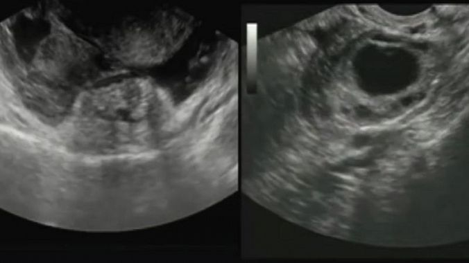 USG - sonografie břicha - obraz při vyšetření, zobrazení dělohy a mimoděložního těhotenství