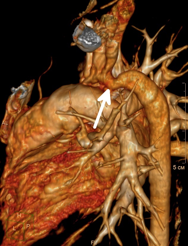 Vizualizace koarktace (zúžení) aorty v sestupné části srdeční cévy.