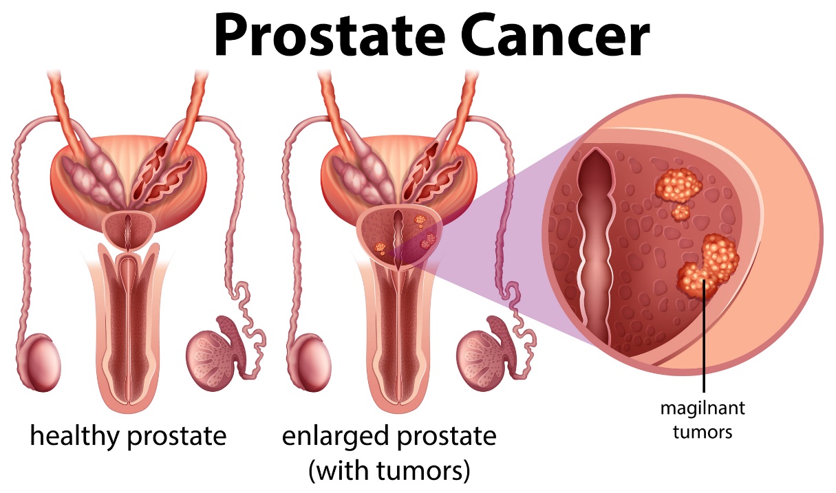 Rakovina prostaty. Zdravá prostata a zvětšená prostata s tumorem