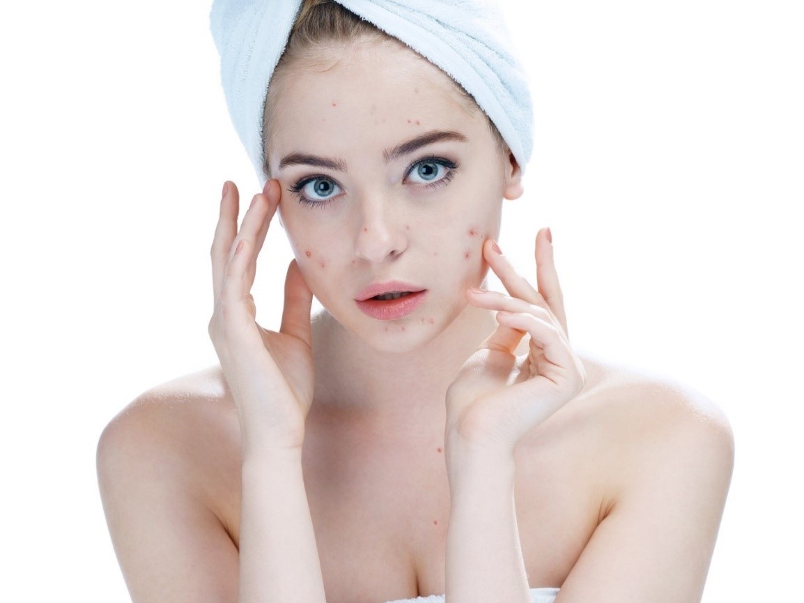 Akné na tváři ženy, vlasy v ručníku