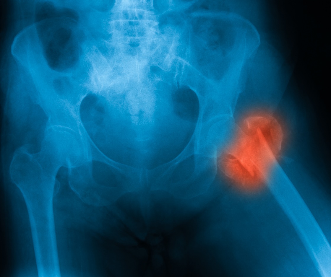 Zlomenina krčku stehenní kosti