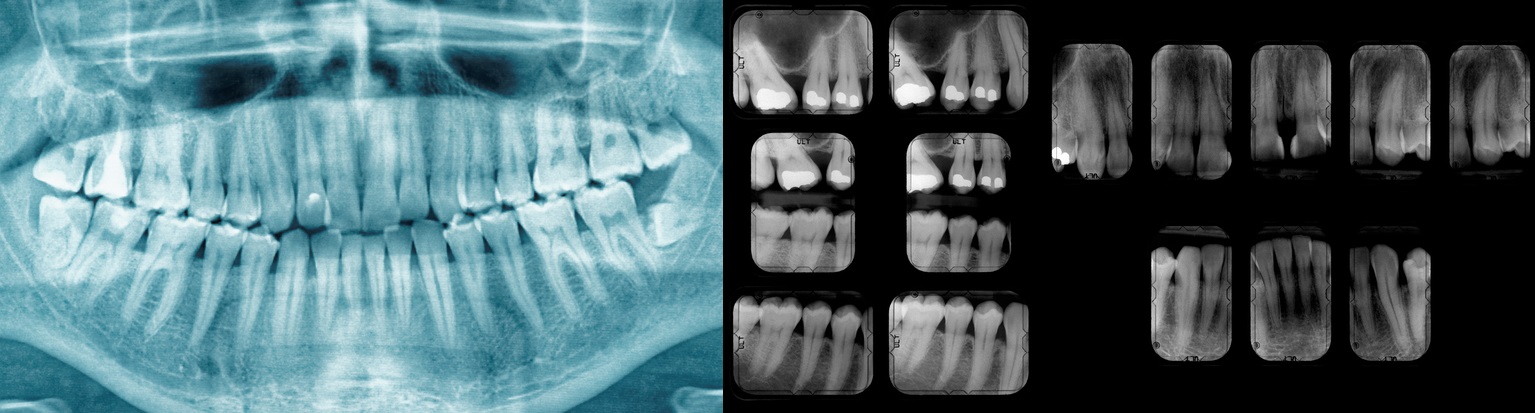 Zubní RTG snímek, který ukáže stav chrupu, zubní kaz i výplně