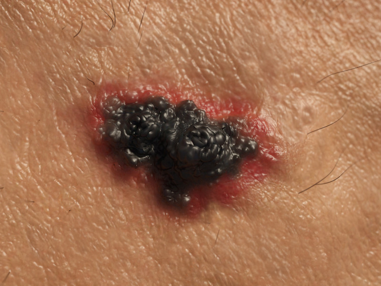 rakovina kůže, maligní melanom černé barvy s červenými okraji