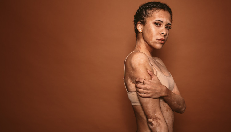 žena s bílými fleky po těle - vitiligo