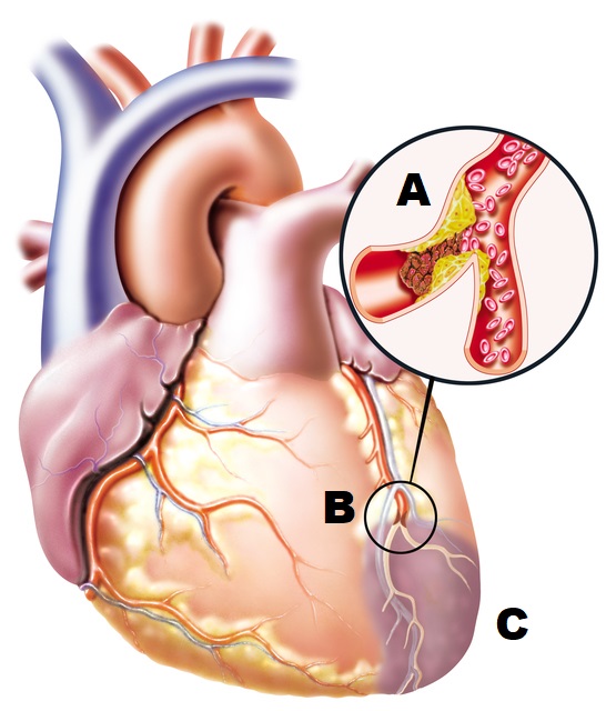 anatomický nákres srdce s ucpanou cévou