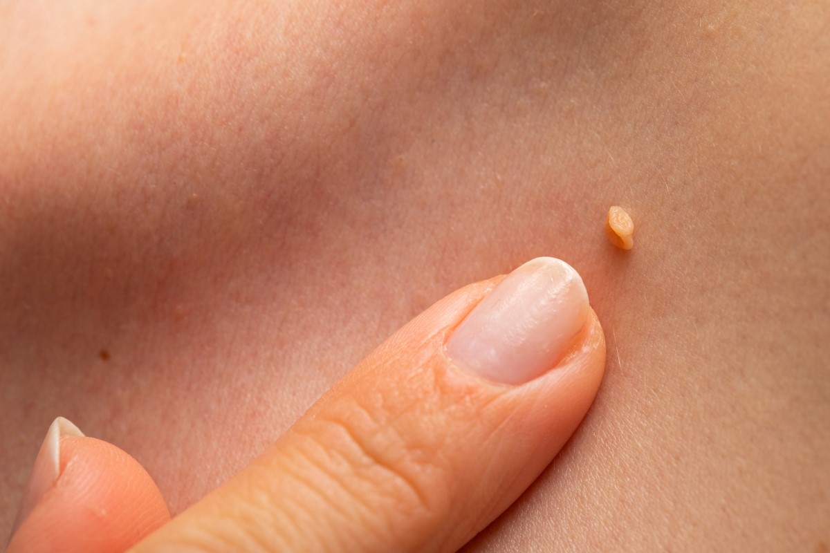 HPV bradavice na kůži ženy