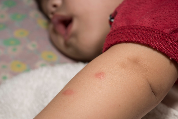 dítě v červeném tričku s poštípanou rukou od komára