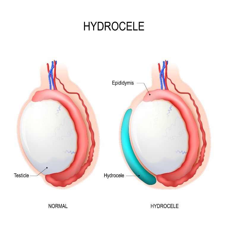 Hydrokéla: Testicle (varle), Epididymis (nadvarle), Hydrocele (nahromaděná tekutina)