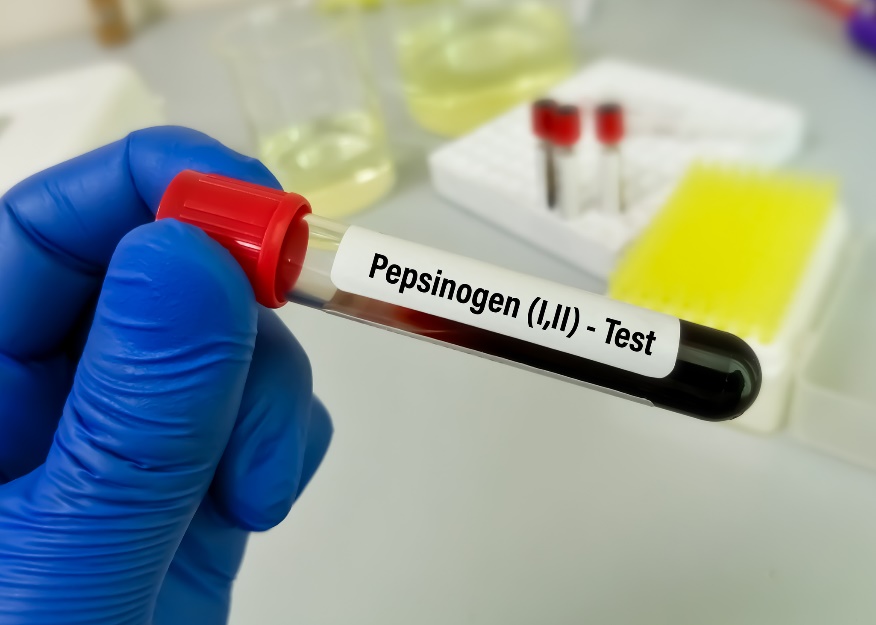 Vzorek krve na laboratorní vyšetření hladiny pepsinogenu a gastro onemocnění