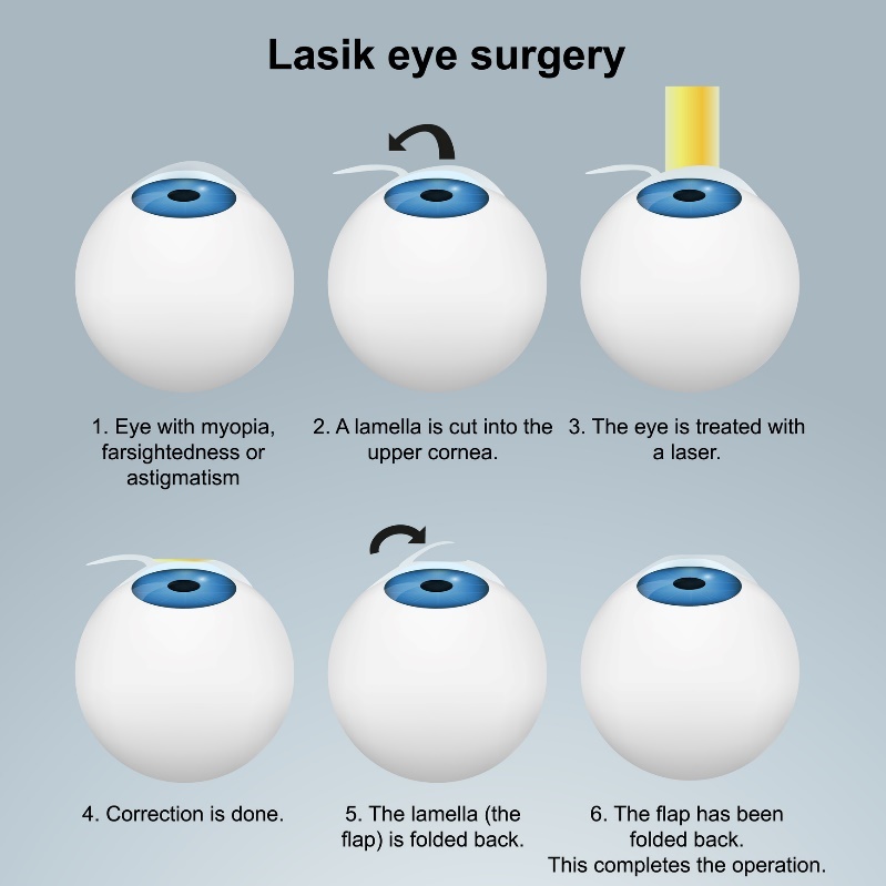 Laserová operace očí LASIK - podpovrchová metoda. Zákrok s lalokem/klapkou bez poškození nervového zakončení.