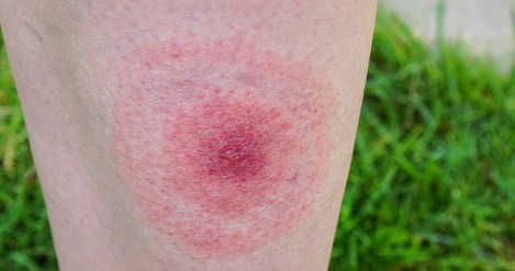 Typický kožní projev boreliózy – migrující erytém
