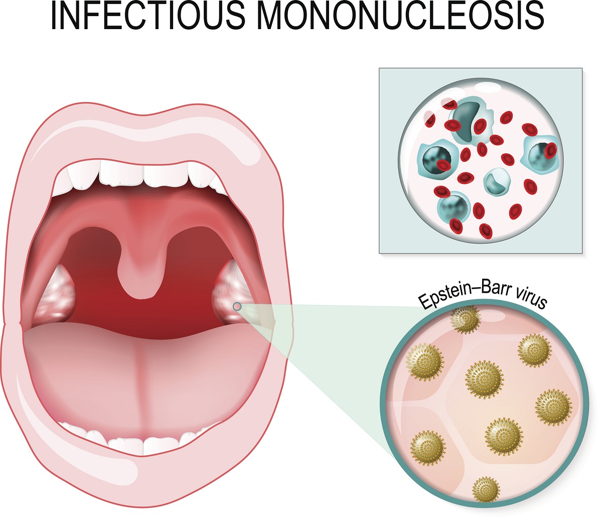 EBV - virus mononukleózy a bolesti v krku. Zdroj fotografií: Getty Images. EBV - virus mononukleózy a bolesti v krku
