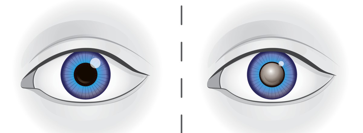 Vlevo: Oko se zdravou čočkou. Vpravo: oko se zakalenou čočkou při šedém zákalu.