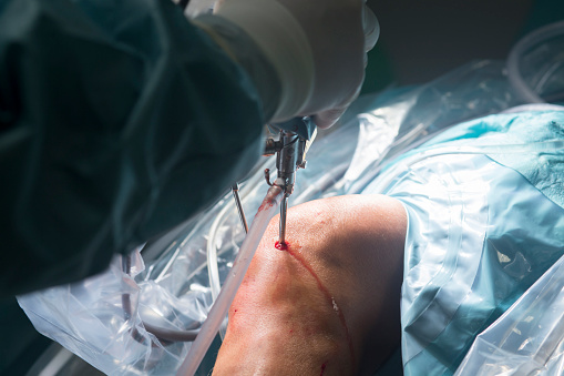 artroskopická operace kolenního kloubu