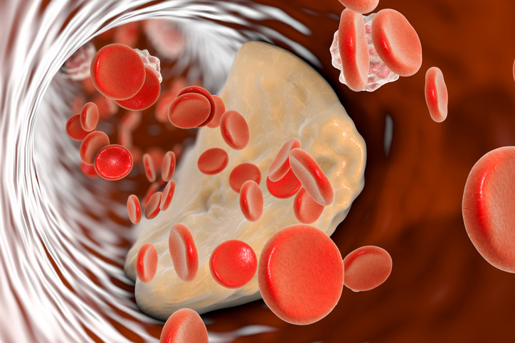 prurez krevní cévou, uvnitr jsou cervené krvinky, tukové cástecky a aterosklerotický plát