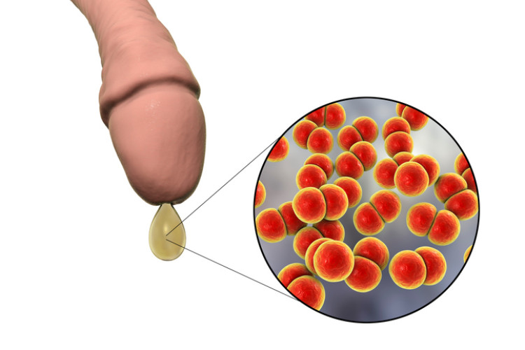 achema penisu s výtokem a mikroskopické bakterie kapavky