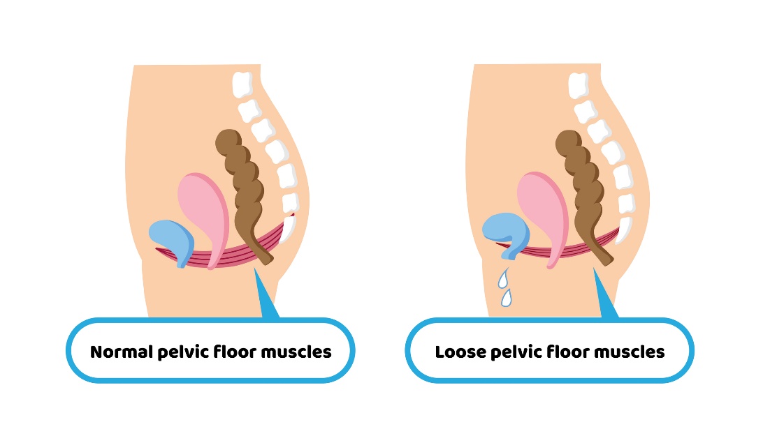 Fyziologický stav svalstva pánevního dna a permisivní stav svalstva pánevního dna s následkem inkontinence