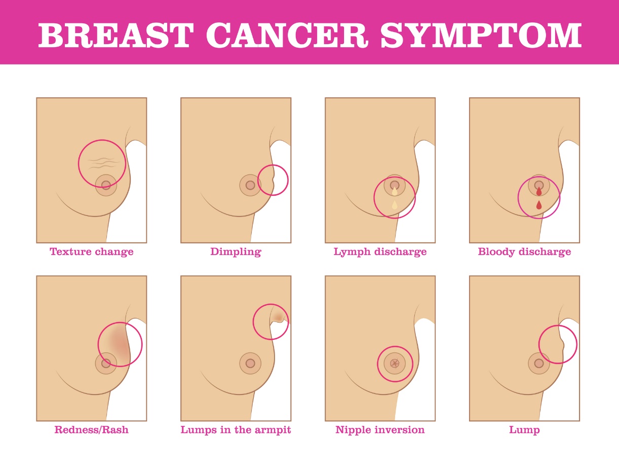 Příznaky rakoviny prsu: změna struktury prsu, změna barvy a povrchu prsu, výtok a vtahování bradavek, lokalizace bulky.