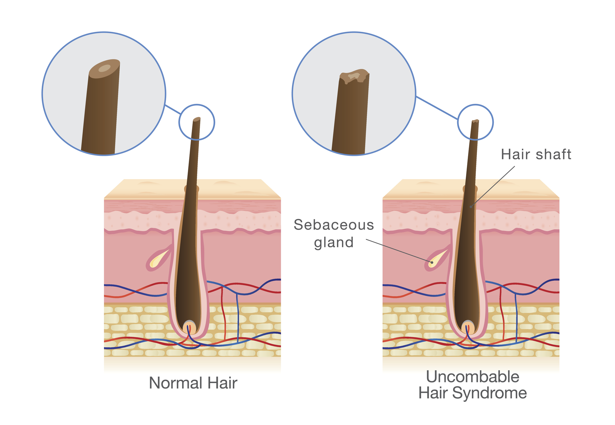Srovnání: vpravo normální vlasy a vlevo vlasy se syndromem nezvladatelných vlasů.