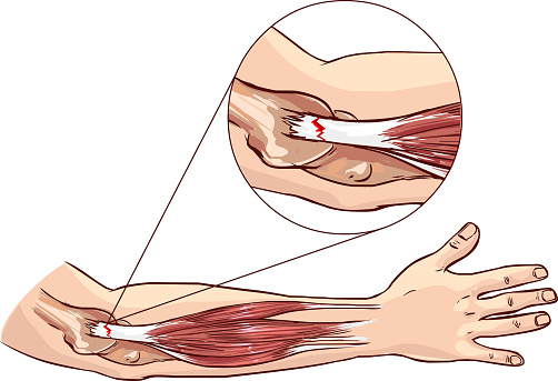 anatomický nástin horní končetiny a úponu šlachy svalů předloktí