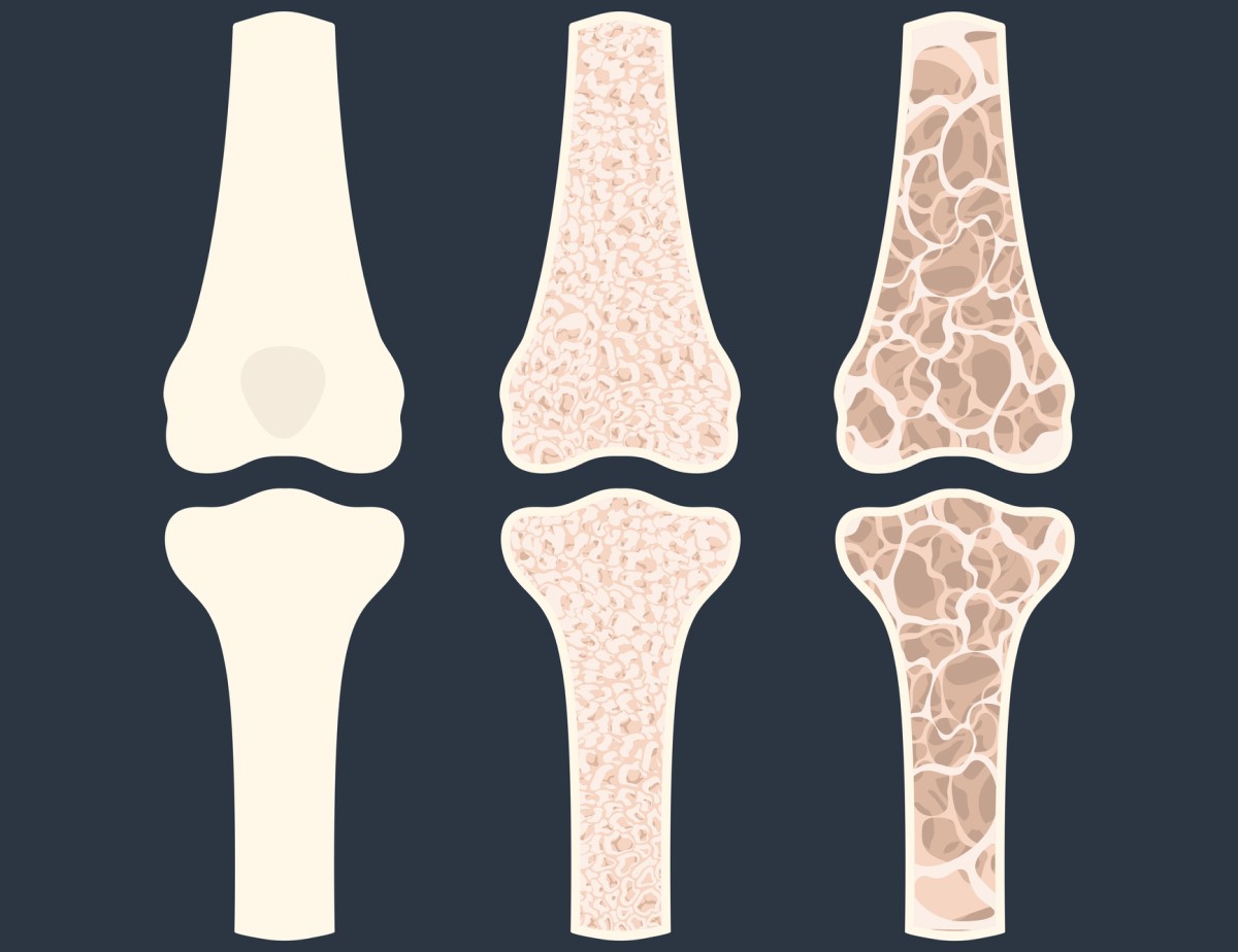 Animace tří kostí ukazující osteoporózu - řídnutí kostí