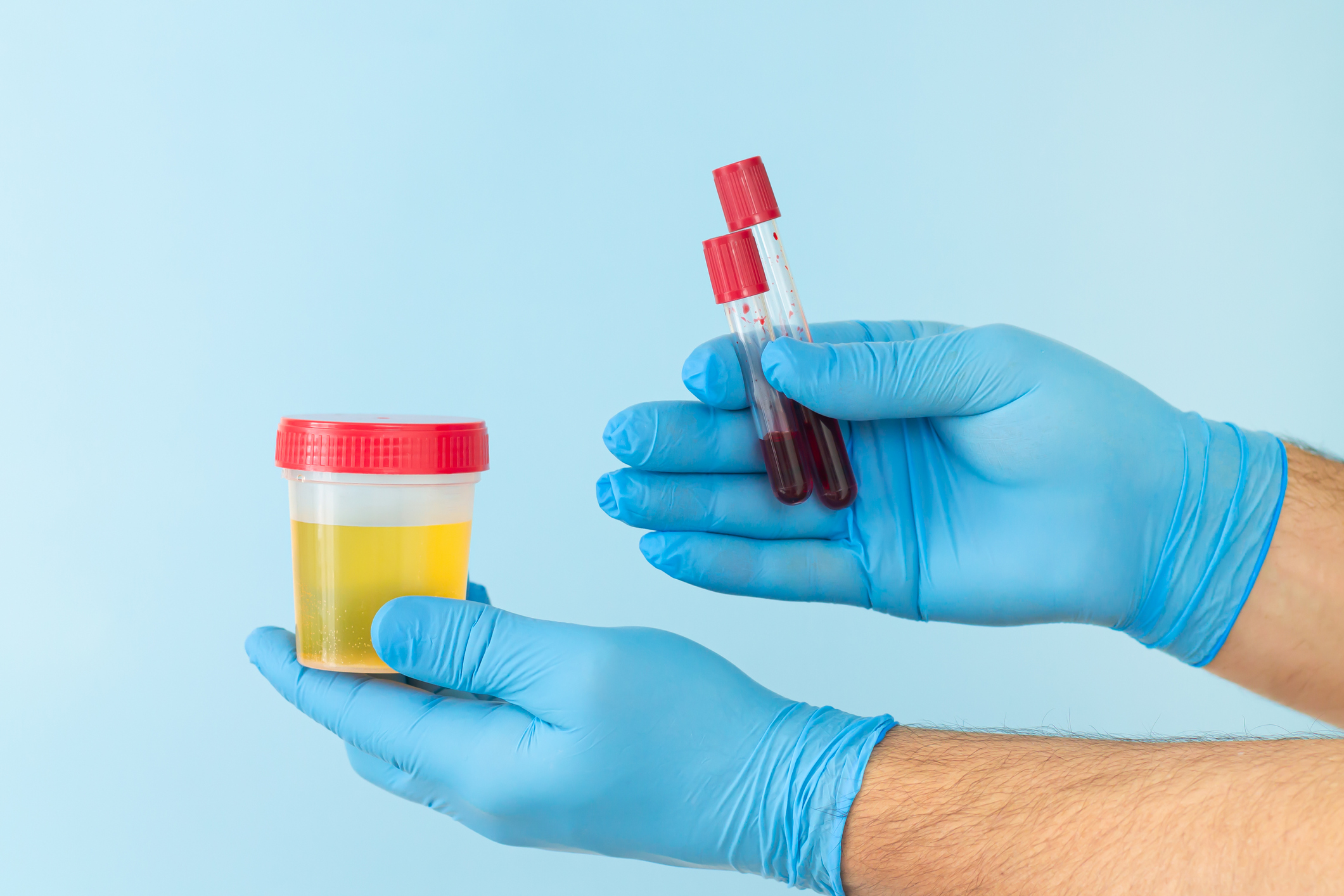 Odchylky od fyziologických hladin chloridů v krvi nebo moči se zjišťují laboratorními testy.