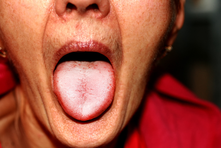 žena v červeném tričku vyplazuje jazyk postižený plísní
