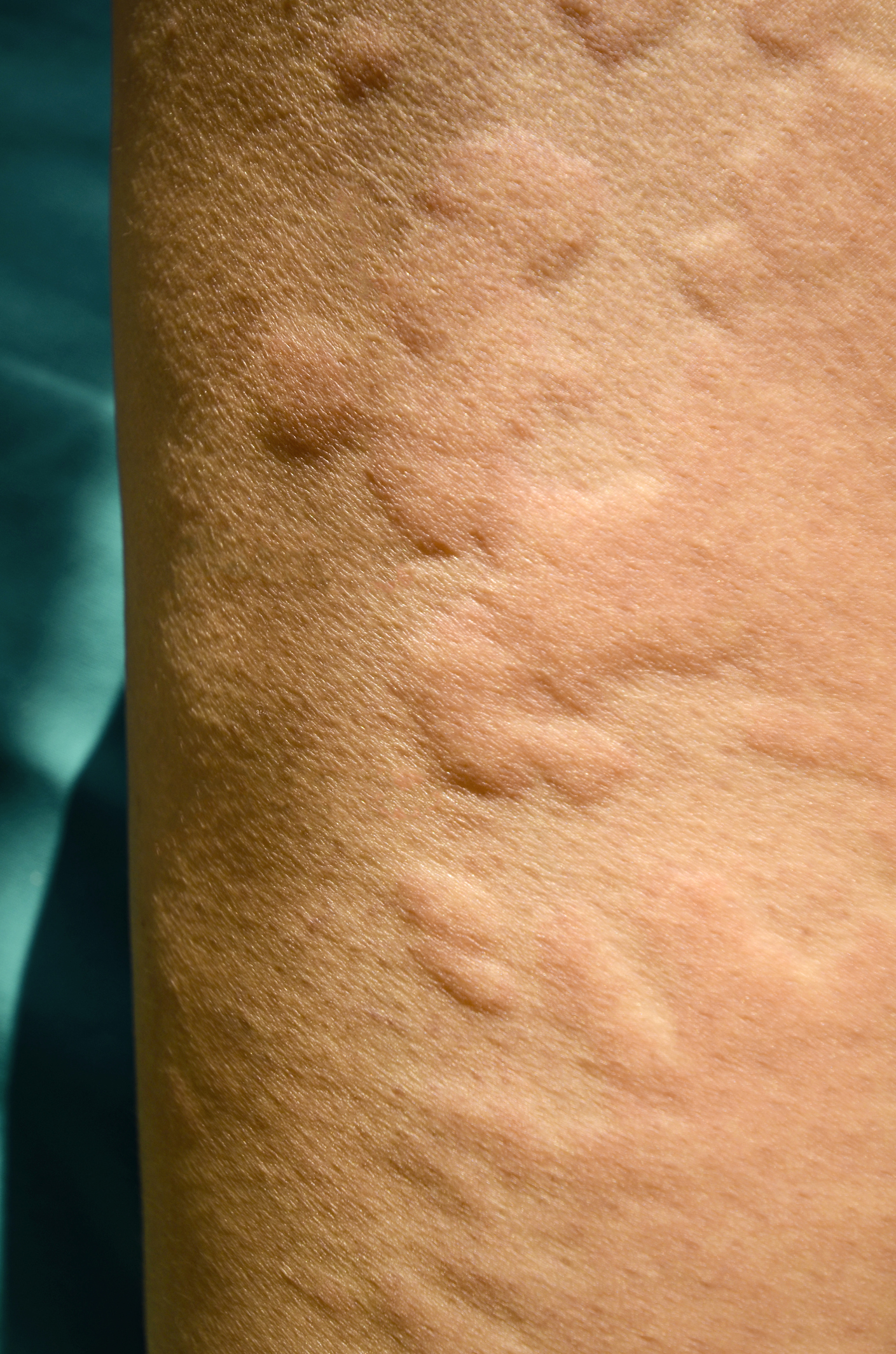 kopřivka alergický ekzém - malé pupeny vystupují nad úroveň pokožky