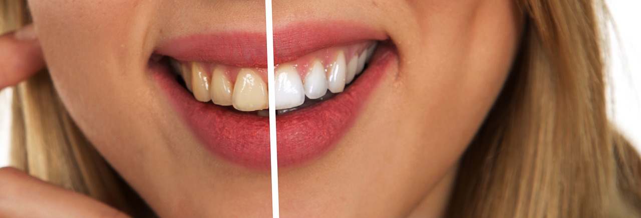 Žena, úsmev, zuby, srovnání zažloutlých zubu a bílých zubu