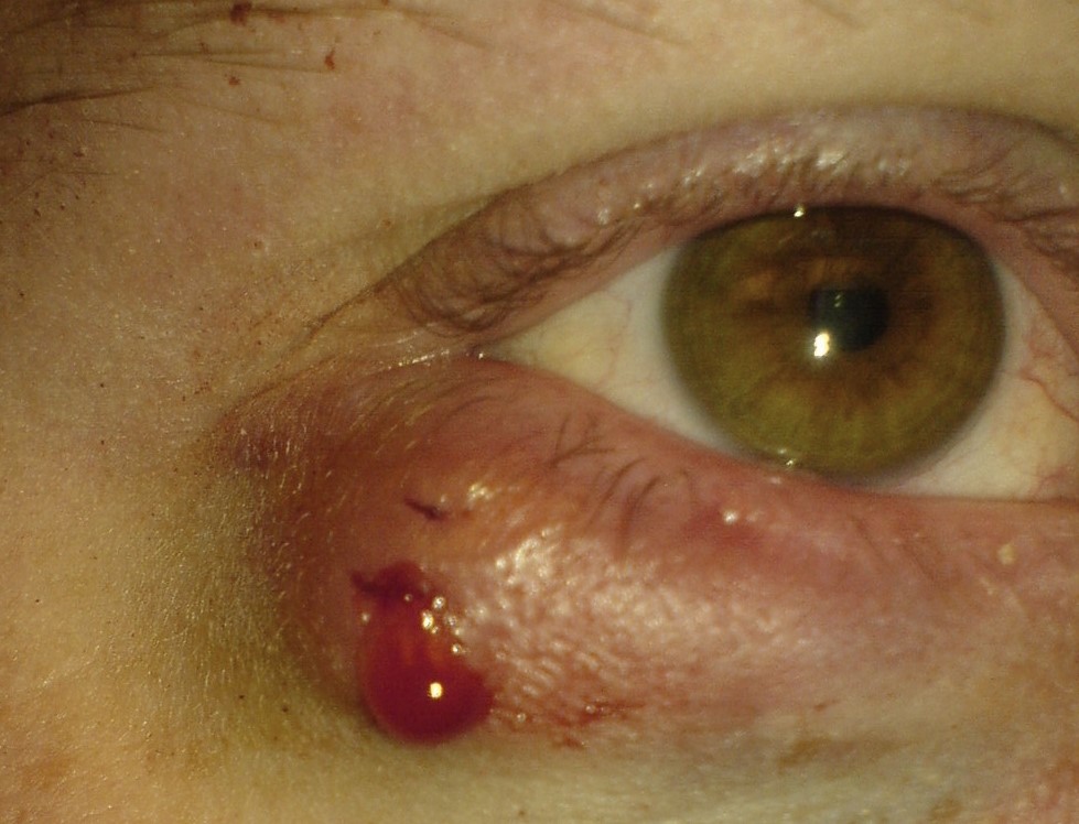 Chalazion, tedy vlčí zrno krvácející po napíchnutí, pro uvolnění tlaku, oční víčko postiženi zánětem, pravé oko