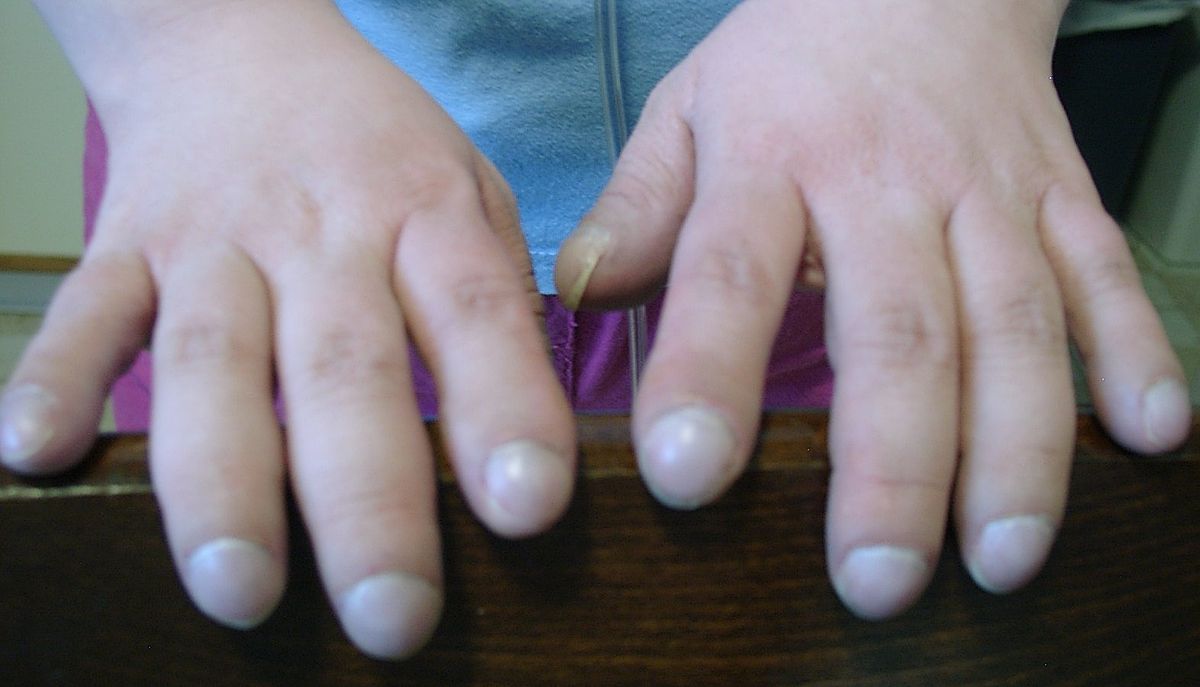 Paličkovité prsty jako příznak Eisenmengerova syndromu