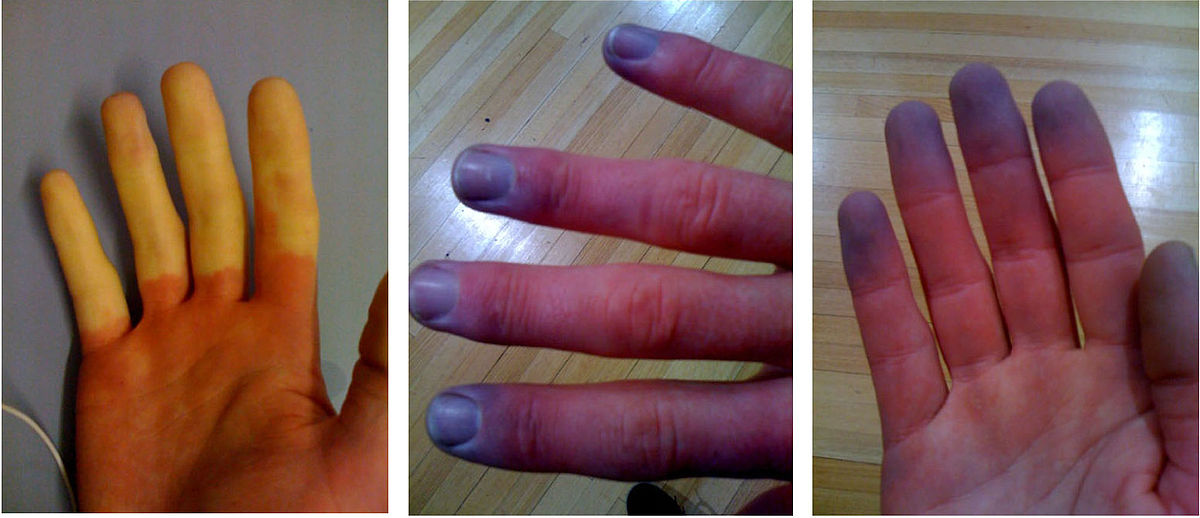 Zbarvení rukou při Raynaudově syndromu, akrální cyanóza