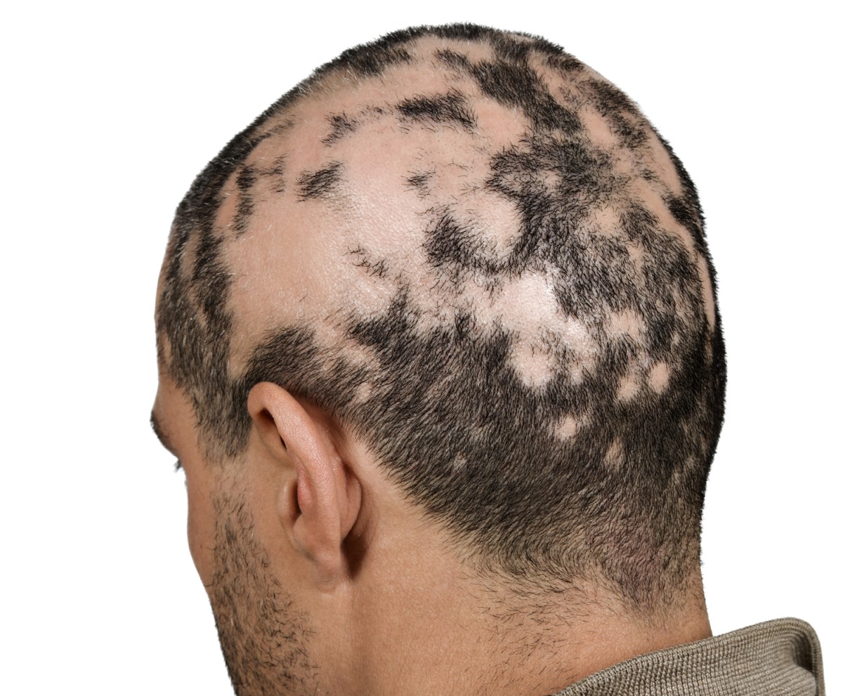 Mužská hlava - padání vlasů - nadměrná ztráta vlasů ve formě ostrůvků - alopecie areata
