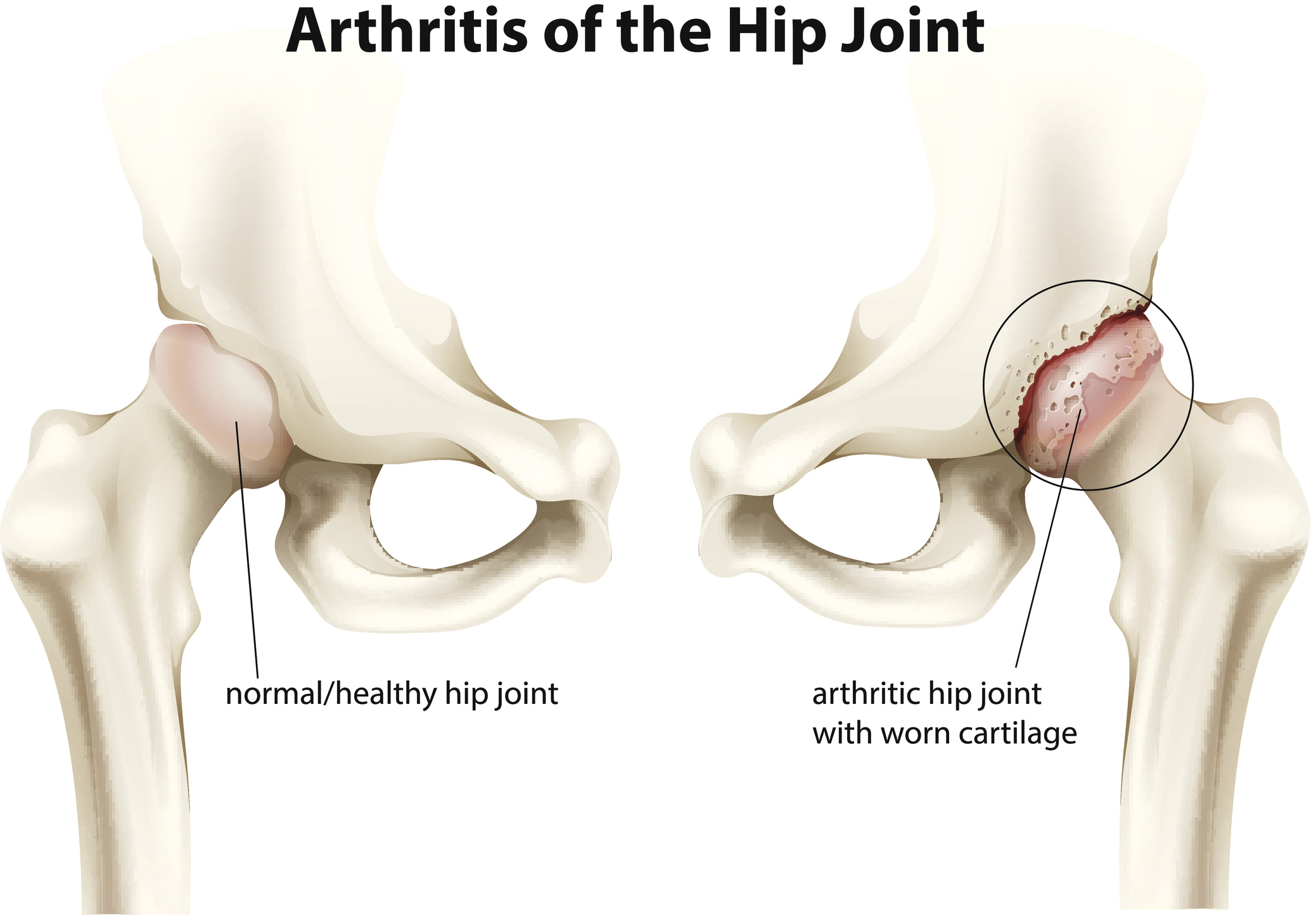 Osteoartróza: ztenčení a poškození chrupavky kyčelního kloubu.