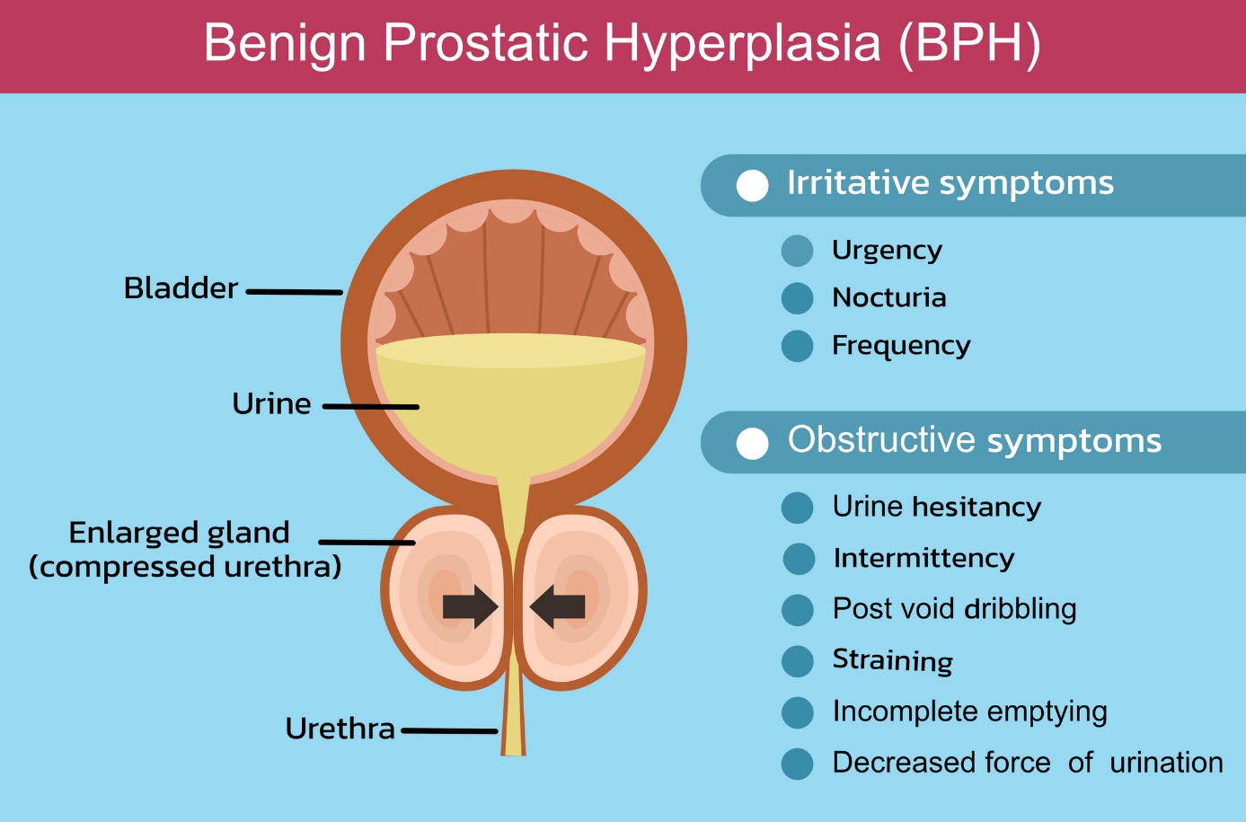 Benigní hyperplazie prostaty - Dráždivé příznaky - nucení na močení, časté močení v noci a časté močení. Obstrukční příznaky - přerušované močení, únik moči po močení, namáhání při močení, nedostatečné vyprazdňování močového měchýře a slabý proud moči. Zdroj fotografií: Getty Images Benigní hyperplazie prostaty a popis v angličtině - bladder, prostata, uretra komprimovaná pro hyperplazii prostaty
