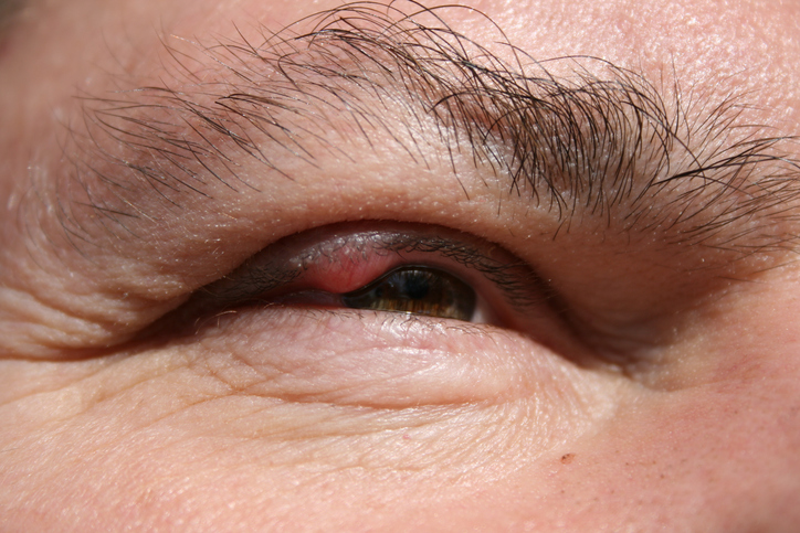 Muž má zanícené horní oční víčko pravého oka, zánět mazových žláz, chalazion, tedy vlčí zrno