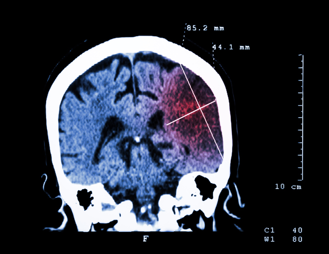 Poškození mozku viditelné na CT vyšetření