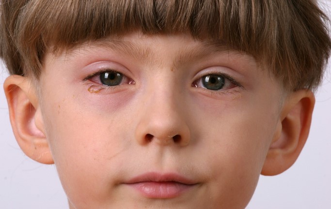 Dítě má zanícené oko, zarudlé a oteklé