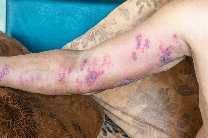 Kožní infekce na pravé horní končetině při herpes zoster, přítomna je i bolest nervů v dané oblasti