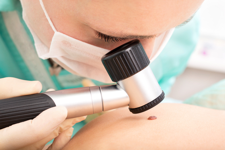 lékař vyšetřuje kožní znaménko dermatoskopem