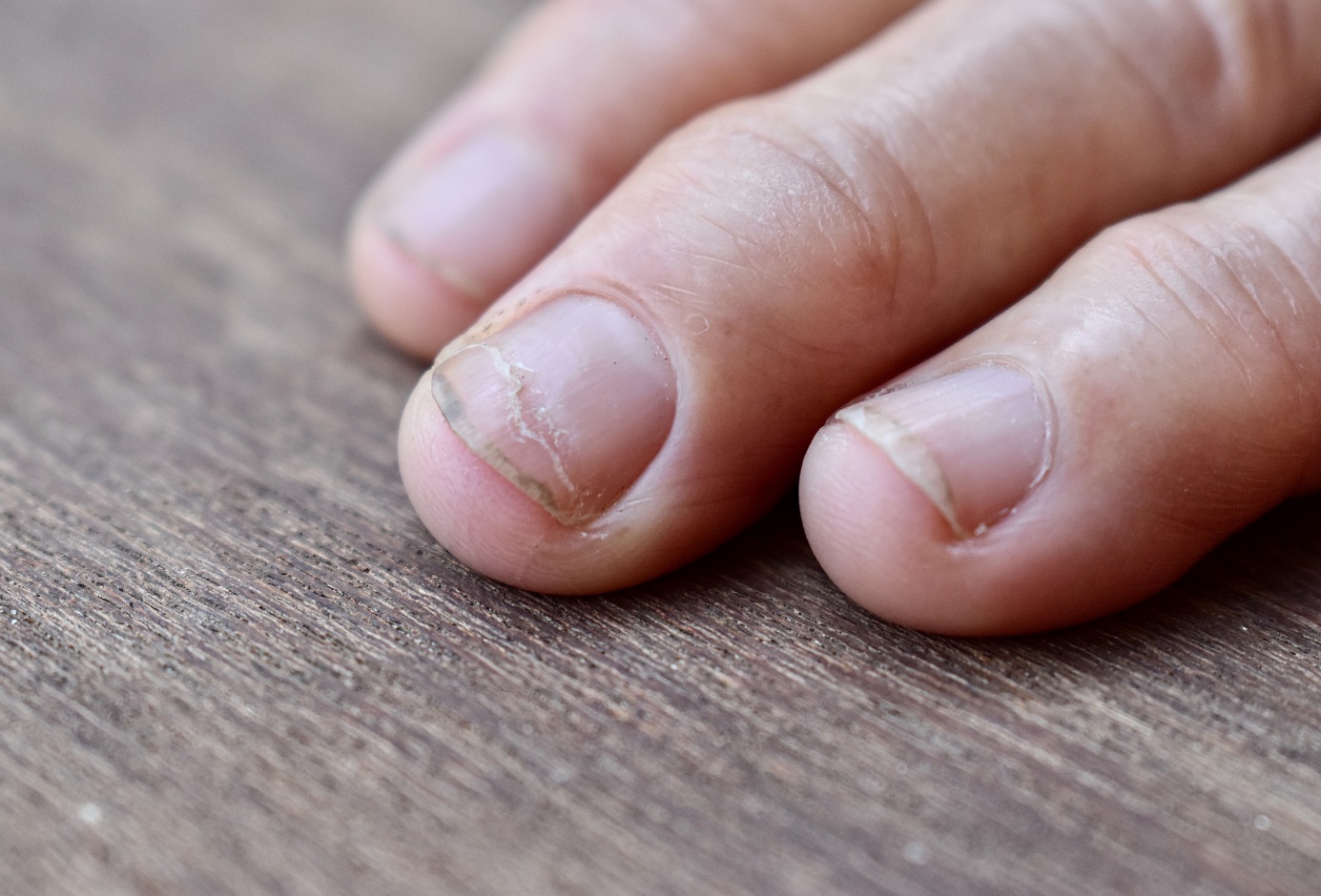 Řezná linie v onychoschizie - na nehtu prstu