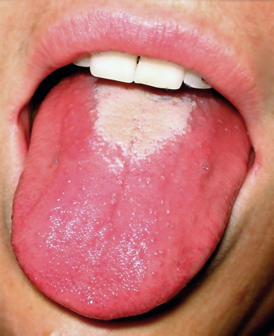 Malinový jazyk při spále