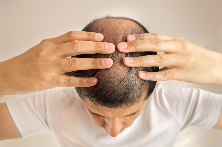 Muž má řídké vlasy, vypadávání vlasů, plešatost, neboli alopecie, ruce na hlavě, pohled shora