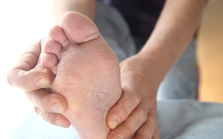 Noha, mykóza, bolest a svědění kůže