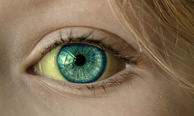 Žluté oční bělmo při ikteru,  žloutence, výřez, detail oka