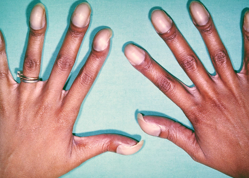 Žena má paličkovité prsty jako příznak onemocnění, a to Fallotova tetralogie