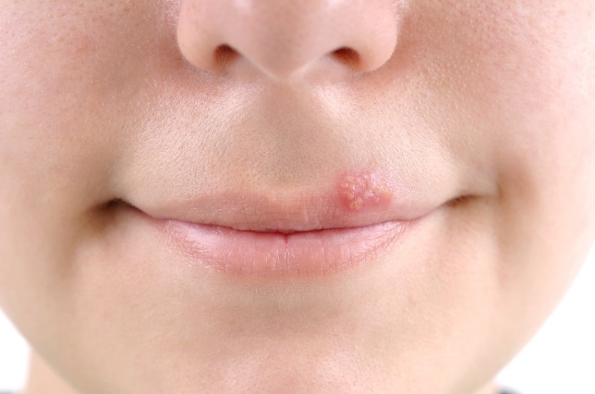 Puchýře - opary (herpes) kolem sliznice úst.